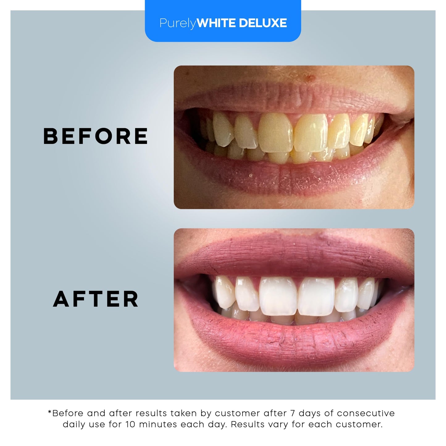 Teeth Whitening Kit with LED